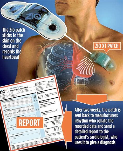 Zio Patch Cardiac Monitoring - herevfil