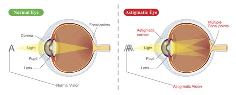 I have astigmatism, so does that mean I'm not suitable for laser eye surgery? | Vision Surgery