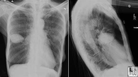 Minor Fissure Lung