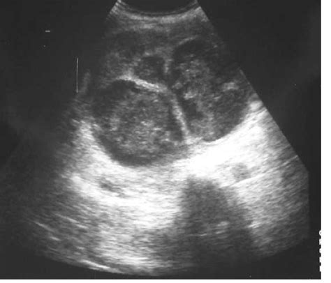 11. a: The appearance of a pyonephrosis on ultrasound. Note the... | Download Scientific Diagram