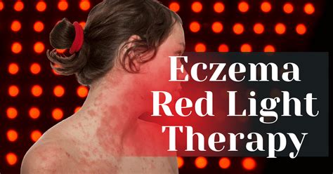 Eczema Red Light Therapy