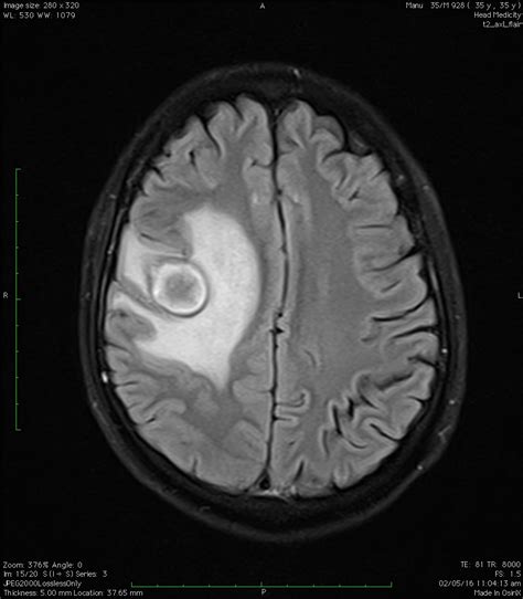 Ultimate Radiology : Frontal lobe abscess : follow up MRI