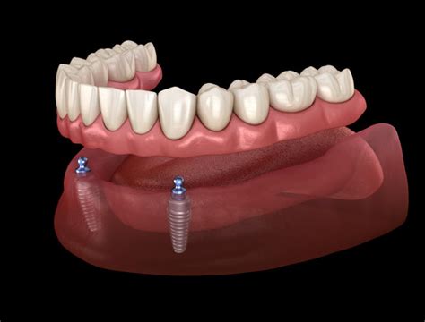 Dental Implants - 2022 Utah - Affordable Dentures From a Certified ...