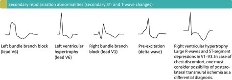 T-waves in ischemia: hyperacute, inverted (negative), Wellens sign & de Winters sign – ECG learning