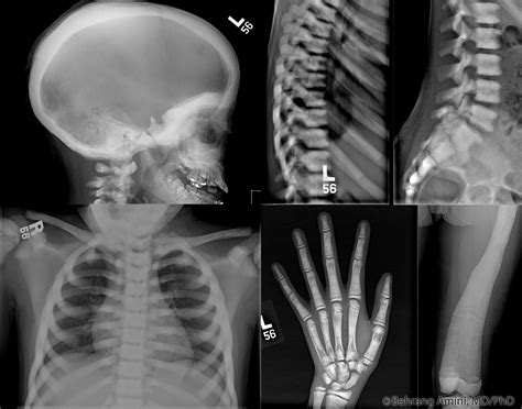 Roentgen Ray Reader: Osteopetrosis