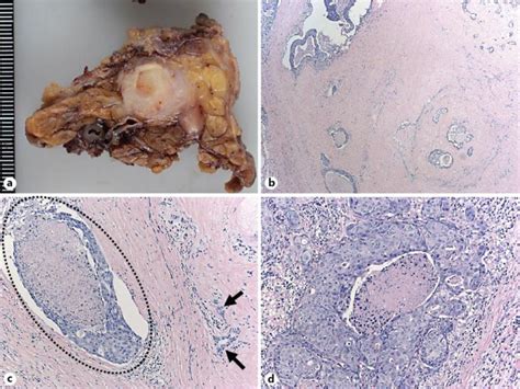 a Macroscopic appearance of the parotid tumor resected. b In the ...