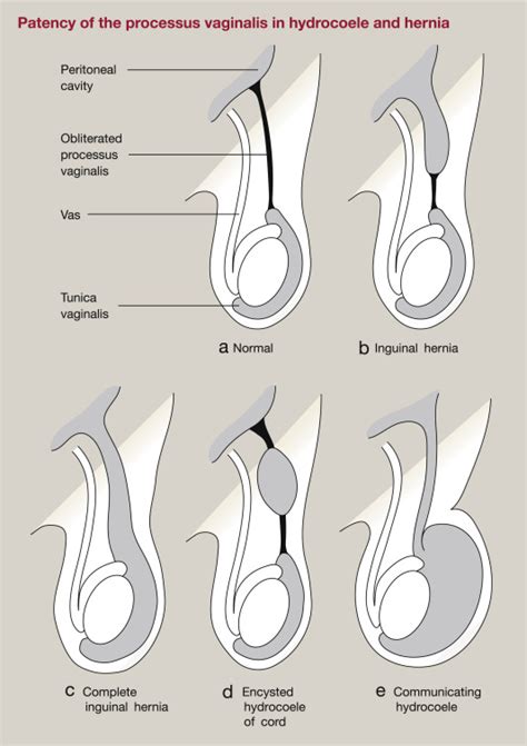 Congenital inguinal hernia, hydrocoele and undescended testis - Surgery - Oxford International ...