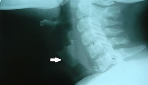 Thyroid Cartilage X Ray