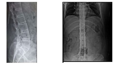 Ankylosing Spondylitis