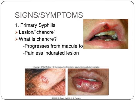 Primary Syphilis