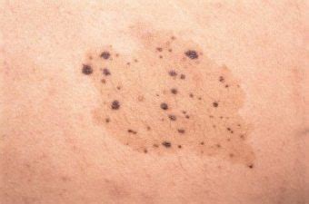 NEVUS SPILUS- SPECKLED LENTIGINOUS NEVUS