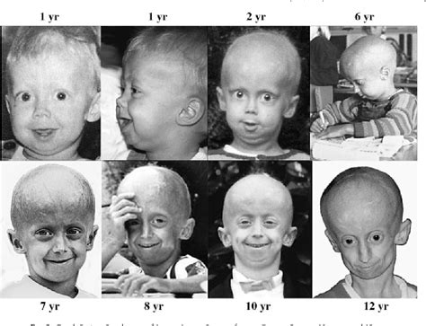 [PDF] Hutchinson-Gilford progeria syndrome: review of the phenotype. | Semantic Scholar