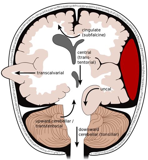 Tiny Tips: ICH for ICH - Brain Herniation - CanadiEM