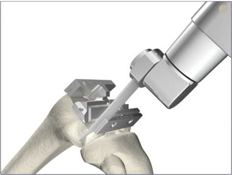 How Mako Robotic Knee Replacement Can Individualize Total and Partial Knee Replacement - CIO