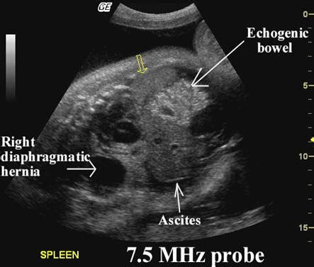 Echogenic Ultrasound