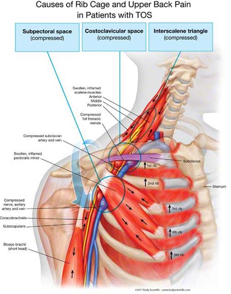 The Subclavius Muscle - The Single Most Super Contracted Muscle of ...