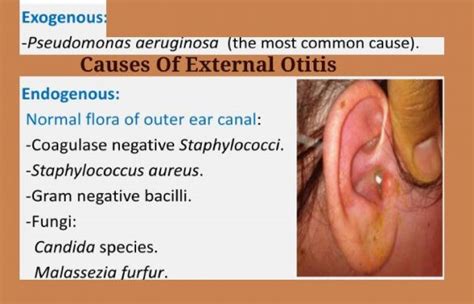 External Otitis- Causes And Its Types & Symptoms And Treatment