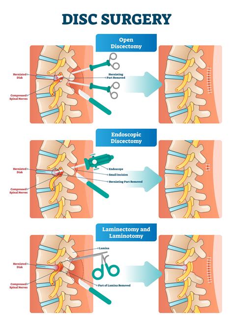 Lumbar discectomy surgery outcomes