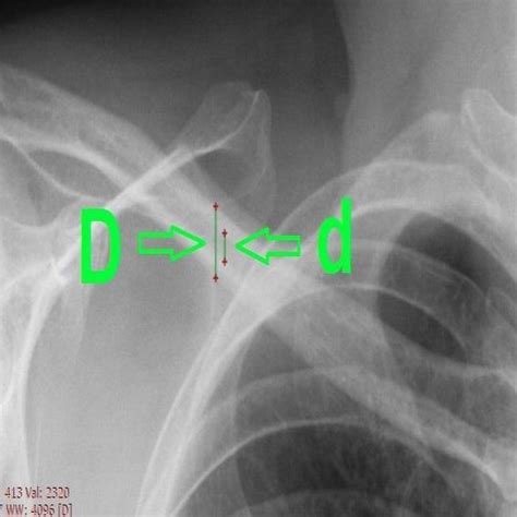 Sample Chest X-Ray Measurement in Clavicle Bone. | Download Scientific ...