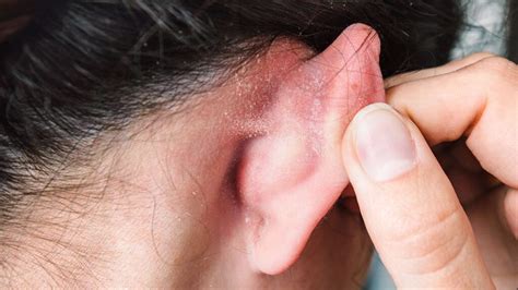 The 10 Possible Causes Of Ear Psoriasis: And How To Avoid Them