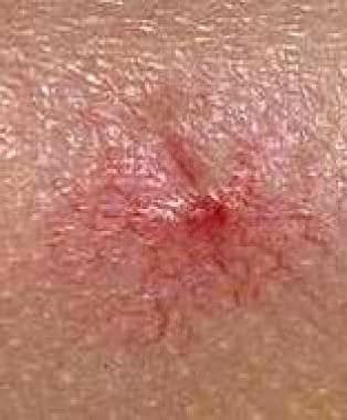 Nevus Araneus (Spider Nevus): Practice Essentials, Pathophysiology, Etiology