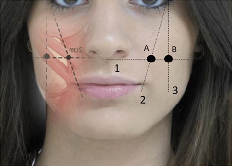 Guidelines for infiltrating major and minor zygomatic muscles. 1, line ...