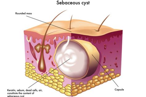 Epidermoid Cysts On Back