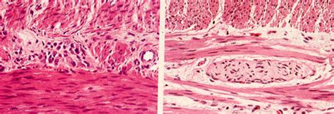 USMLE Pathology Slides - Hirschsprung’s disease The frame on your left...