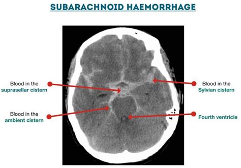 Understanding Basics and How to Read Head CT Scan