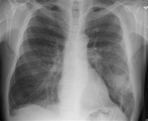 Organizing pneumonia Case 246 | Left lower lobe large nodula… | Flickr