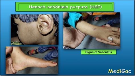 Henoch-Schonlein Purpura(HSP) - Clinical features || Pathophysiology ...