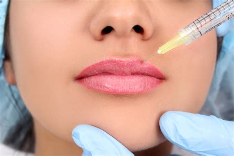 The perfect pout: how to use lip fillers - Dentistry.co.uk