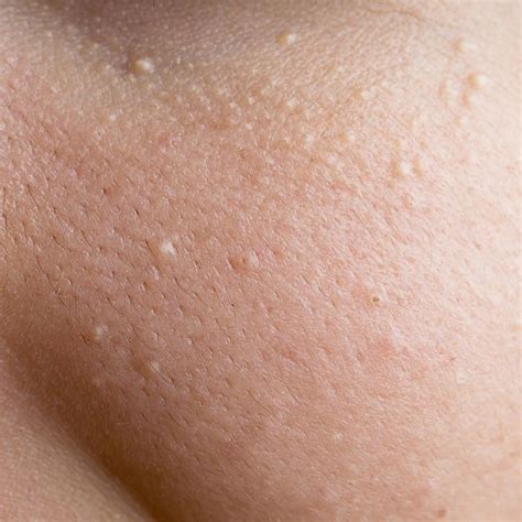 12 Bumps On Your Skin That Are Totally Normal—And You Shouldn't Pop ...