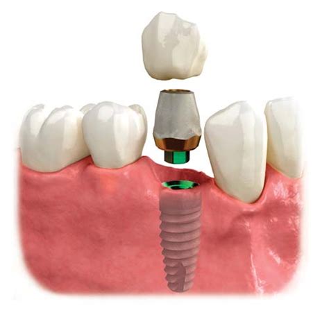 Dental Implants from Dental Associates