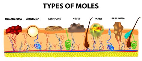 Meaning Of Mole On Sole Of Right Foot Best Sale | emergencydentistry.com