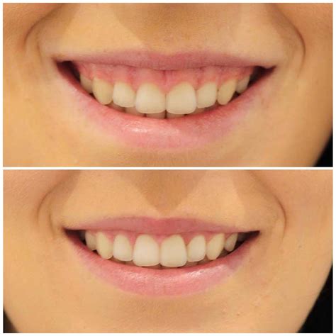 Gum Lifts Brisbane [Free Consult] | Smiling Dental