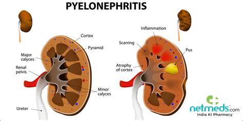 Pyelonephritis/Kidney Infection: Causes, Symptoms And Treatment