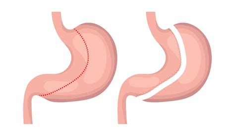 Gastric Sleeve Recovery Time | What is Healing Timeline for Sleeve Surgery