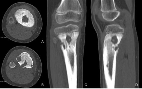 -CT scan. (A) and (B) Axial plane with bone window at different levels ...