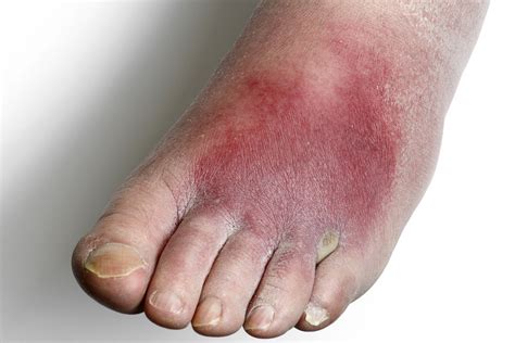 Cellulitis - NHS