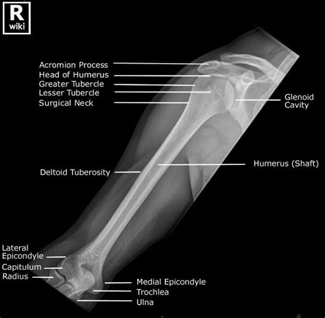 Radiographic Anatomy of the Humerus | Medical radiography, Radiology ...