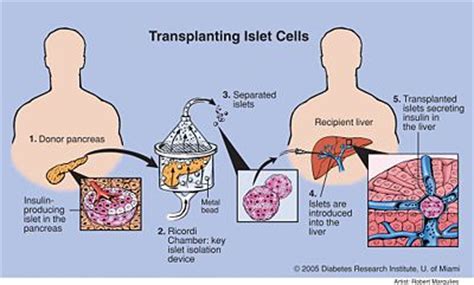 Pancreatic Islet Transplant - The Transplant Decision