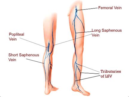 Varicose Veins, Superficial Veins, Deep Vein, Perforating Veins,