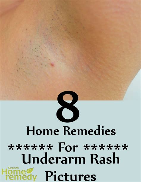 8 Home Remedies For Underarm Rash Pictures | Search Home Remedy