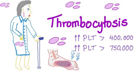 Thrombocytosis (Primary and Secondary) - Why Is My Platelet Count High? - Hematology - YouTube