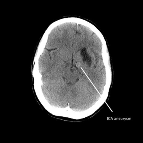 Case Study – Left ICA Aneurysm