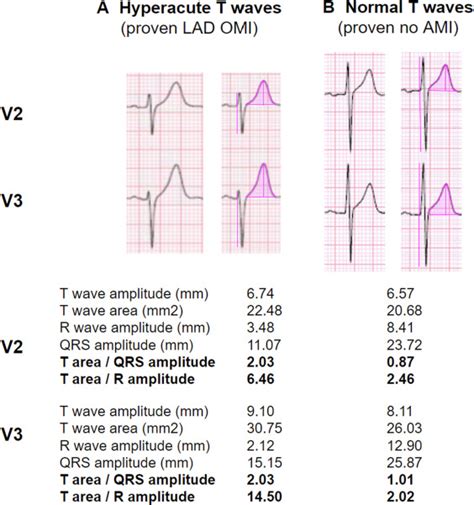 Hyperacute T-waves Can Be a Useful Sign of Occlusion Myocardial ...