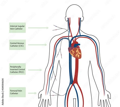 Plakat Catheter Positioned In A Men S Body Internal Jugular Vein | Hot Sex Picture