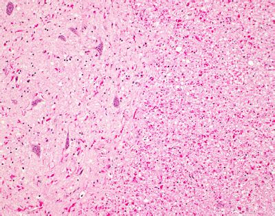 neuropathology blog: A case of Alexander disease