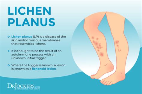 Lichen Planus: Symptoms, Causes and Support Strategies